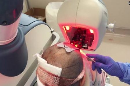 injerto-capilar-con-robot